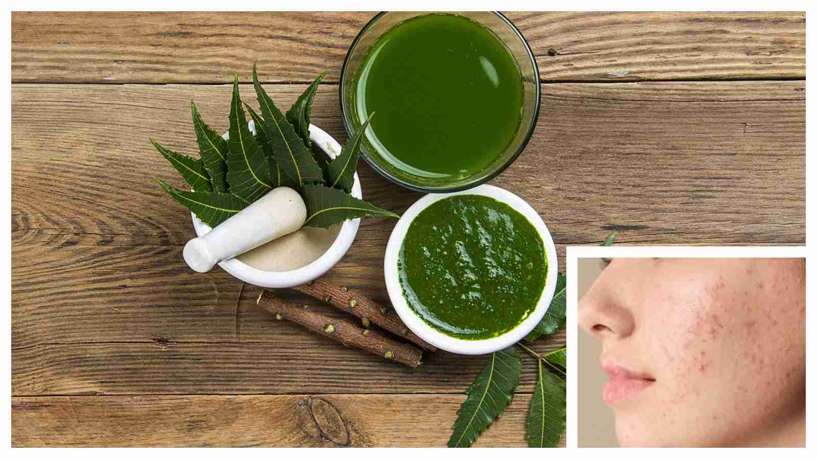 How to use neem to reduce acne and pimples without wrecking your skin