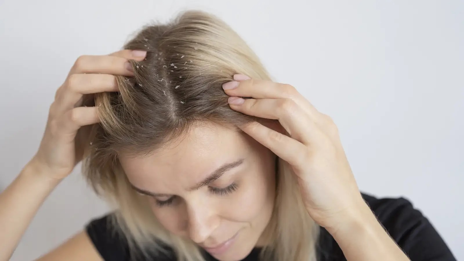 Tired of oily and sticky dandruff? Here are 6 quick fixes you need
